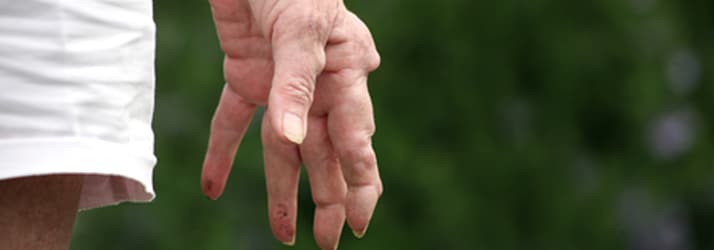 arthritis hand